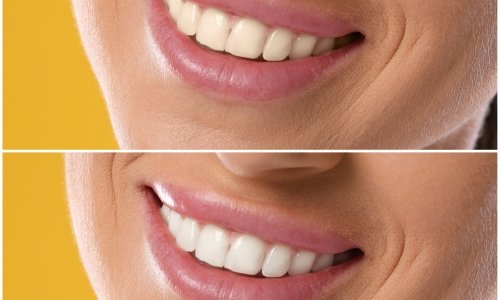 Digital Smile Design